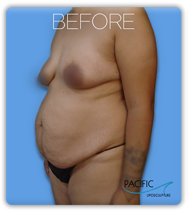 Procedure before and after - before
