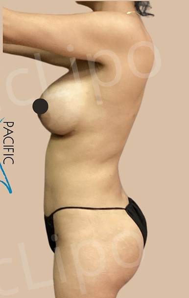 Procedure before and after - after