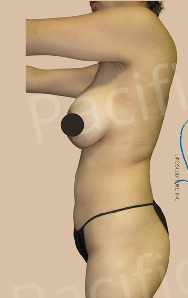 Procedure before and after - before
