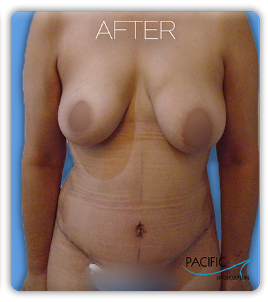Procedure before and after - after