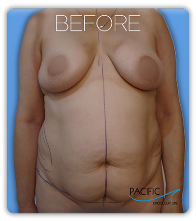 Procedure before and after - before