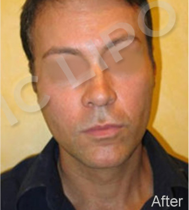 Procedure before and after - after