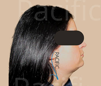 Procedure before and after - before