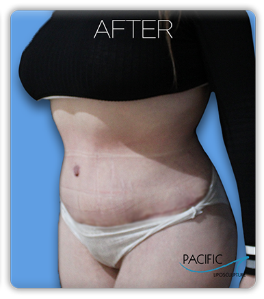 Procedure before and after - after