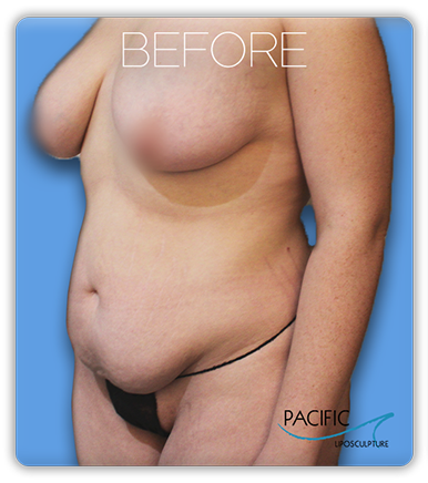 Procedure before and after - before