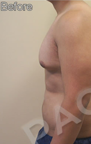 Procedure before and after - before