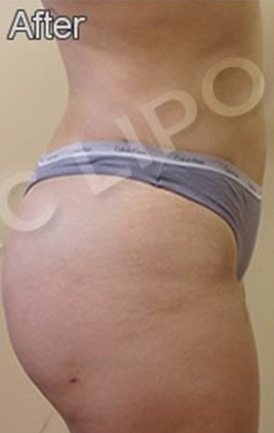 Procedure before and after - after