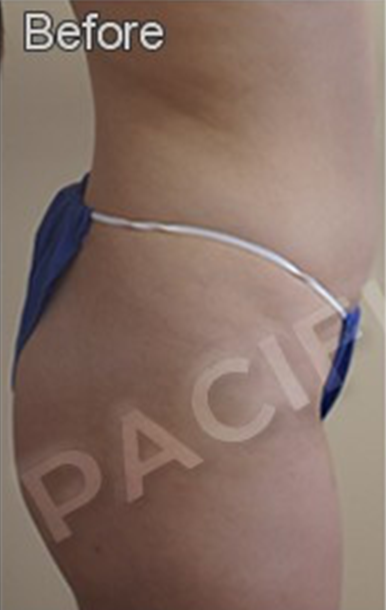 Procedure before and after - before