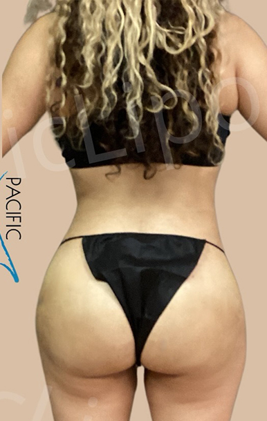 Procedure before and after - after