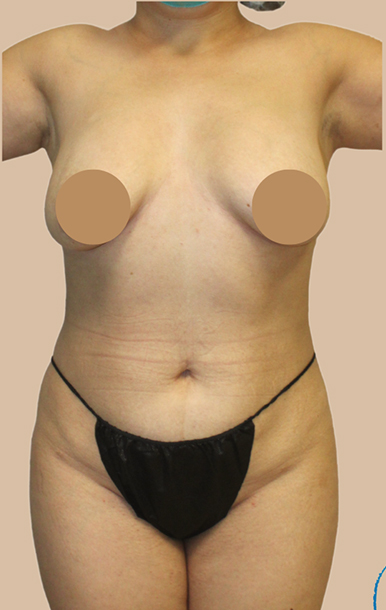 Procedure before and after - before