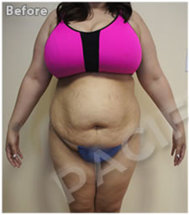 Procedure before and after - before
