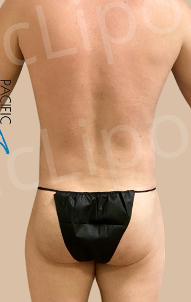 Procedure before and after - after