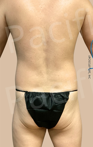 Procedure before and after - before