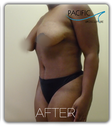Procedure before and after - after