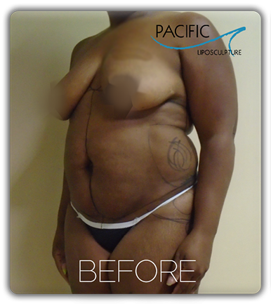Procedure before and after - before