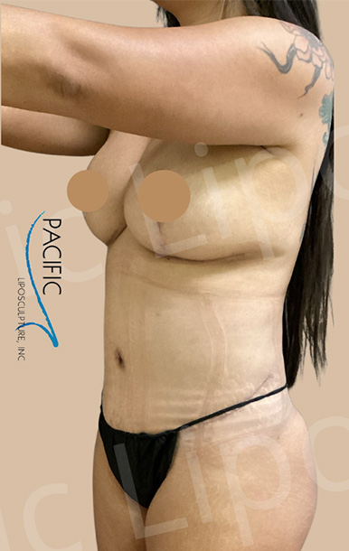 Procedure before and after - after
