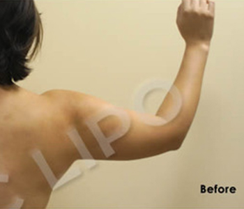 Procedure before and after - before