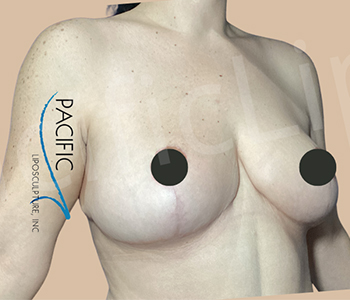 Procedure before and after - after