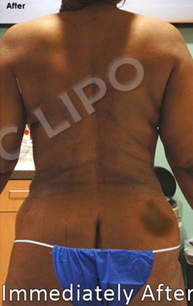 Procedure before and after - before