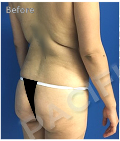 Procedure before and after - before