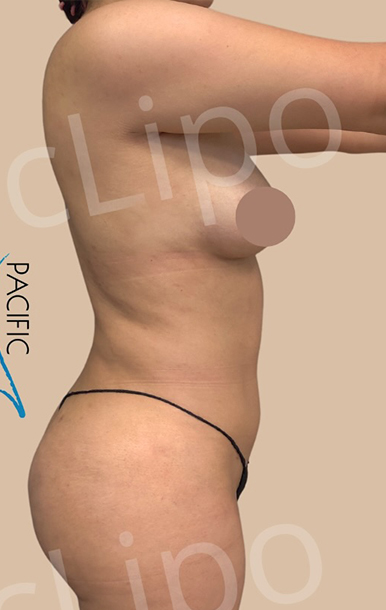 Procedure before and after - after