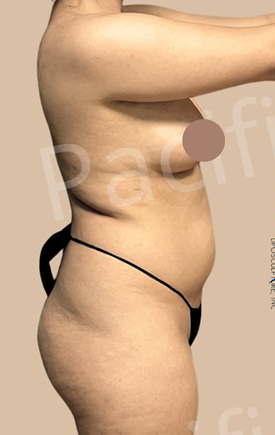 Procedure before and after - before
