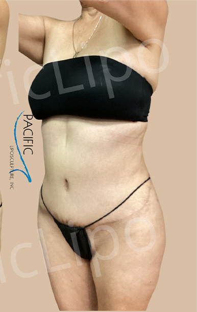 Procedure before and after - after