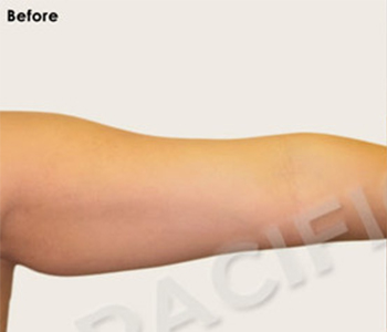 Procedure before and after - before