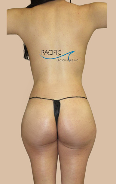 Procedure before and after - after