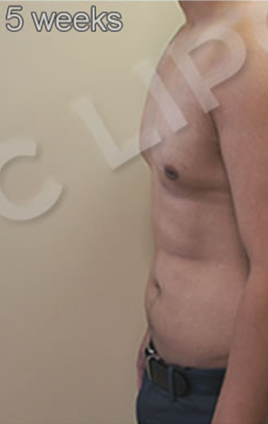 Procedure before and after - before