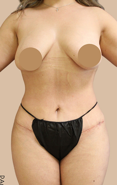Procedure before and after - after