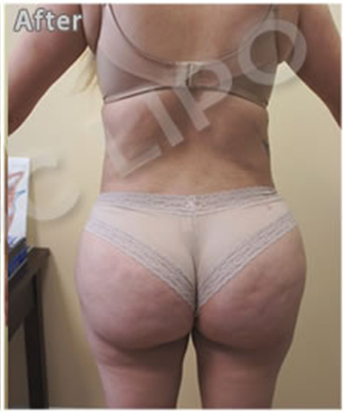 Procedure before and after - after