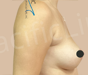 Procedure before and after - after