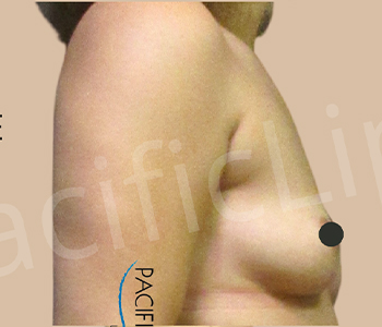 Procedure before and after - before
