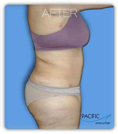 Procedure before and after - after