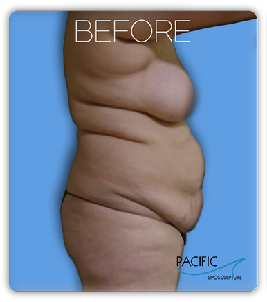 Procedure before and after - before