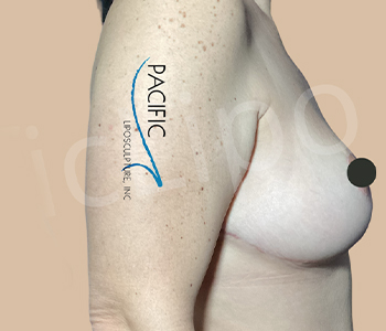 Procedure before and after - after