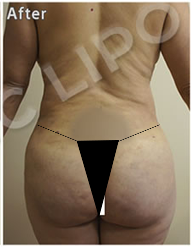 Procedure before and after - before