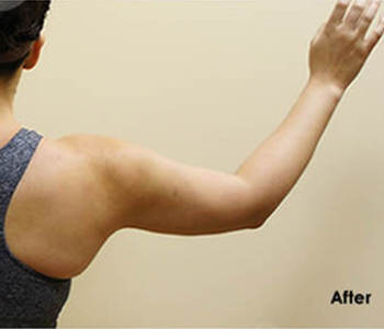 Procedure before and after - before