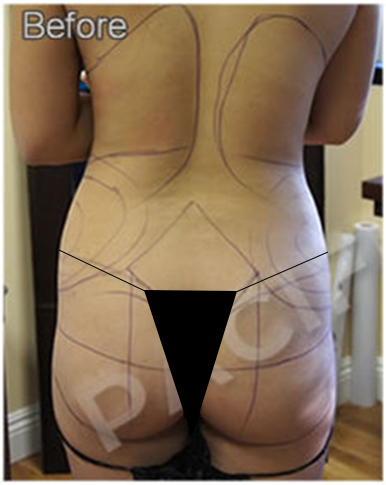 Procedure before and after - before