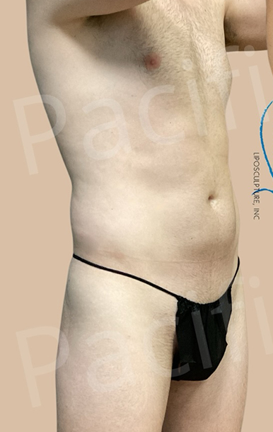 Procedure before and after - before