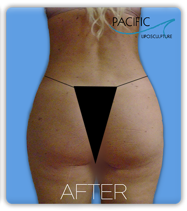 Procedure before and after - before