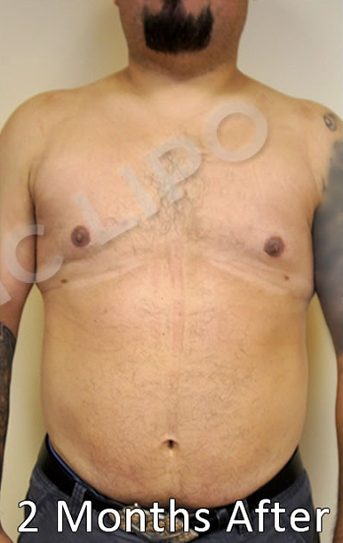 Procedure before and after - before