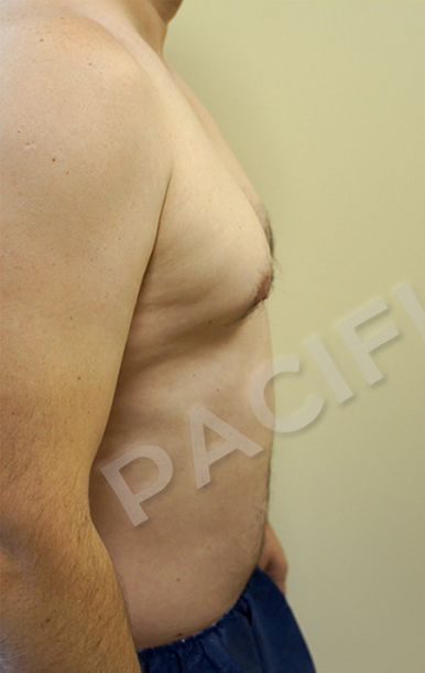 Procedure before and after - before