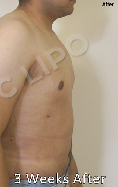 Procedure before and after - before