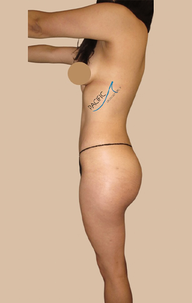 Procedure before and after - after