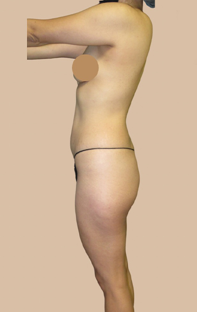 Procedure before and after - before