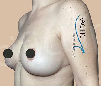 Procedure before and after - after