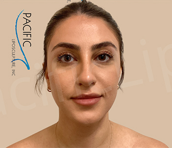 Procedure before and after - after