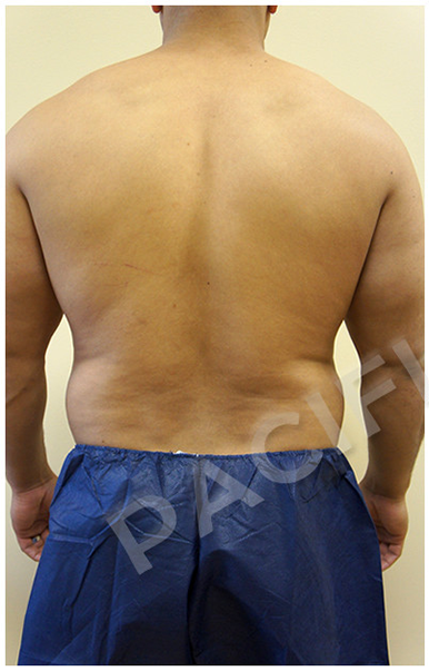 Procedure before and after - before